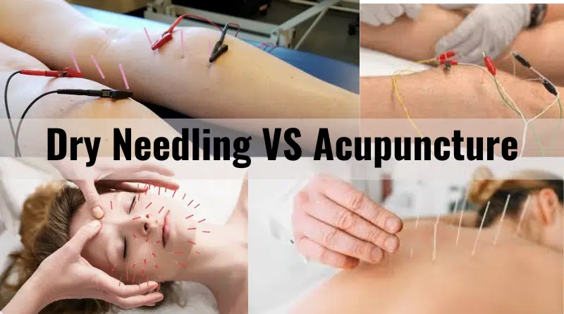 Dry Needling VS Acupuncture